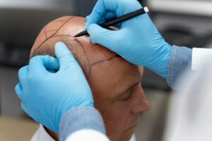 Homme subissant un processus d'extraction d'unités folliculaires. meilleures cliniques de greffe de cheveux à Paris