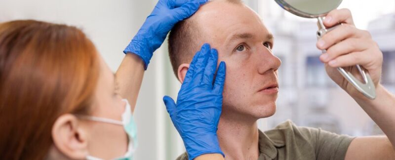 Homme adulte ayant des problèmes de calvitie. greffe de cheveux en France